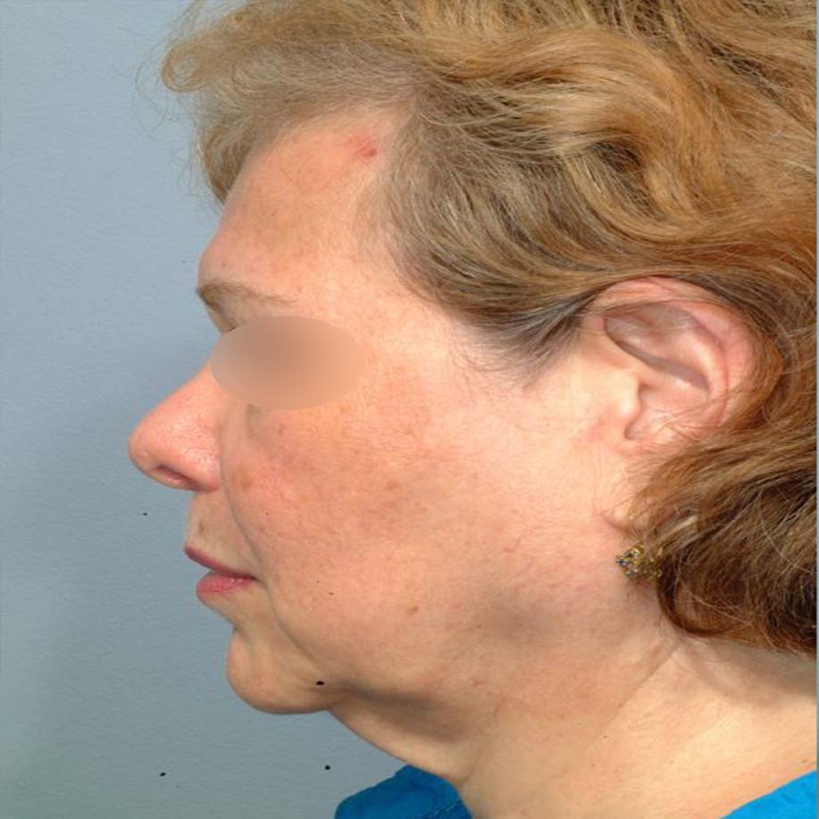 لیپوماتیک صورت، گردن و ناحیه زیر چانه (غبغب)