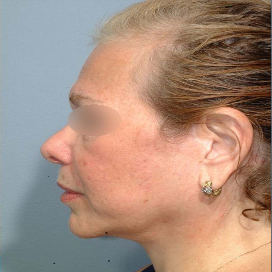 لیپوماتیک صورت، گردن و ناحیه زیر چانه (غبغب)